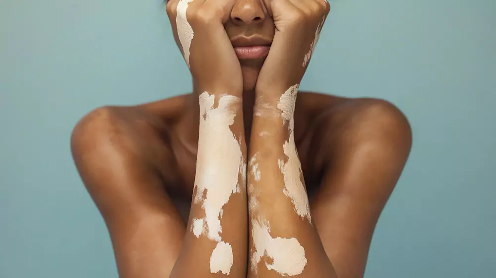 Vitiligo Surgery