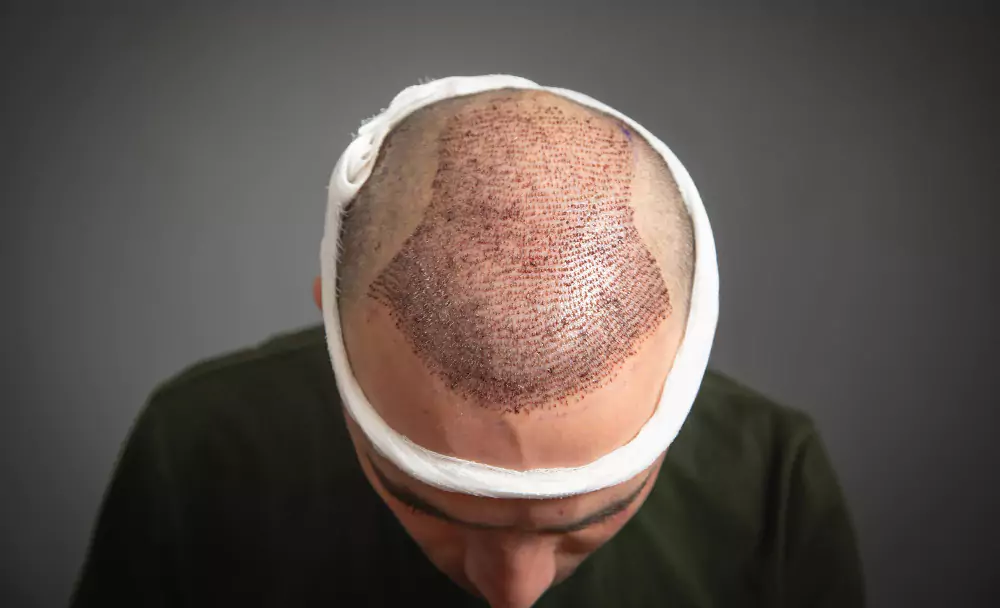 Hair Transplant
